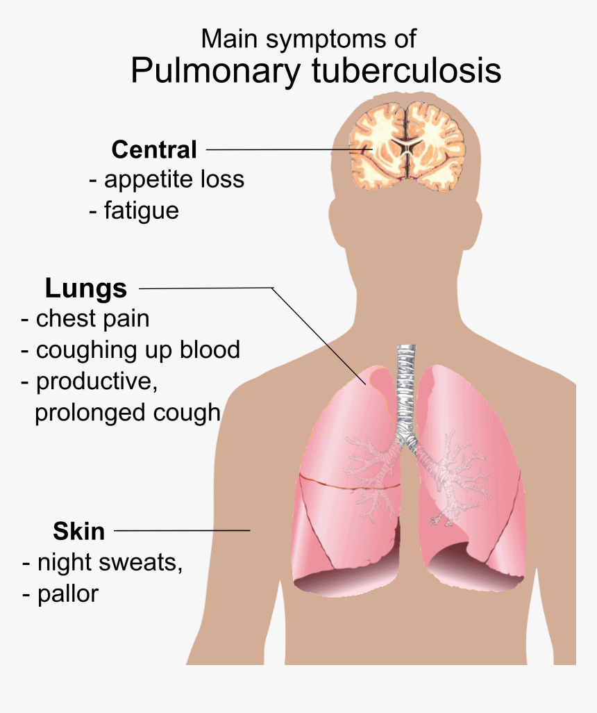 Pulmonary Tuberculosis Symptoms - Main Symptoms Of Pulmonary Tuberculosis, HD Png Download, Free Download