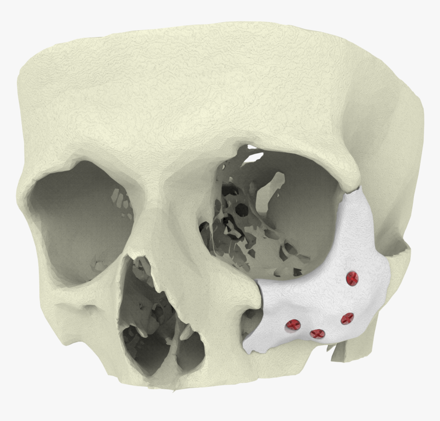 Maxillofacial Surgery Trauma 3d Printing, HD Png Download, Free Download