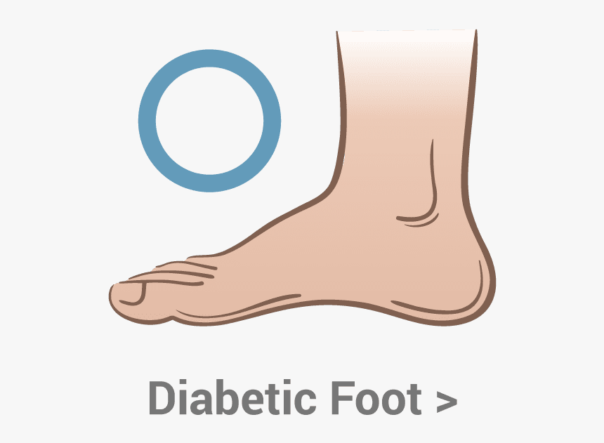 Diabetic-foot, HD Png Download, Free Download