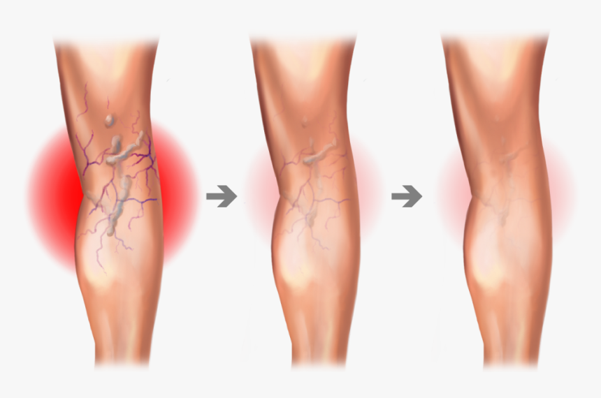 Varicose Vein Graphic, HD Png Download, Free Download