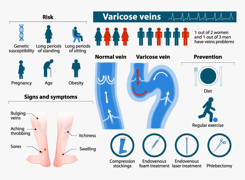 Varicose Veins Infographic, HD Png Download, Free Download