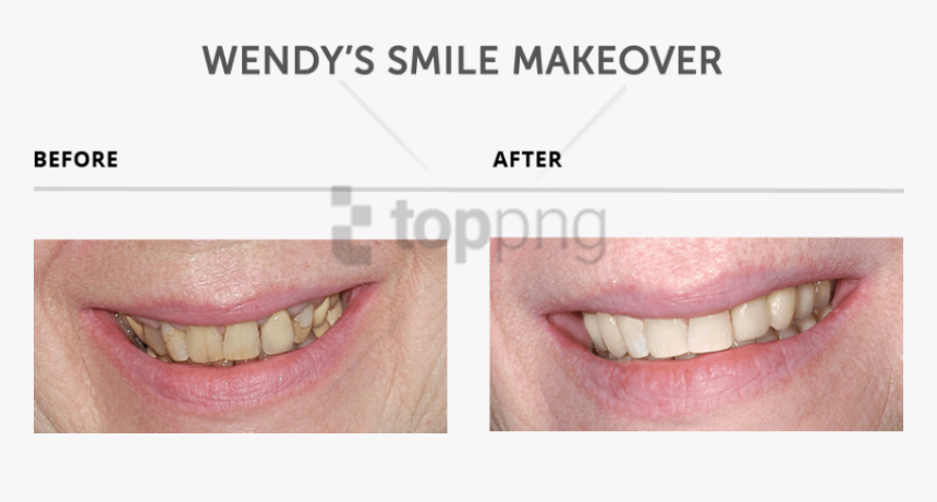 Free Png Download Teeth Makeover Png Images Background - Slim Jim, Transparent Png, Free Download