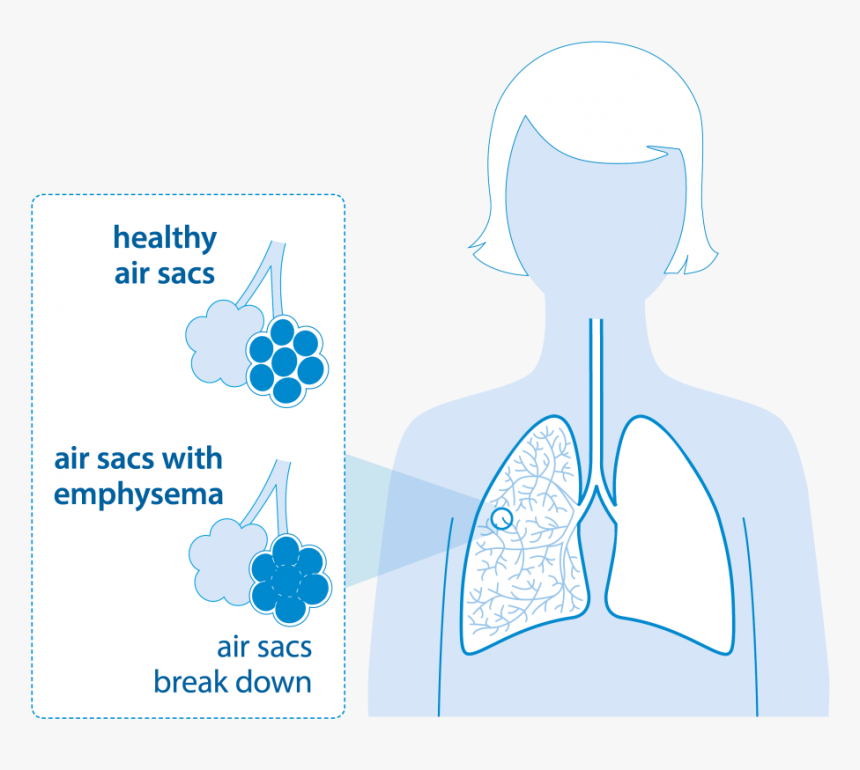 diagram-of-lungs-with-emphysema-lung-reduction-surgery-copd-hd-png