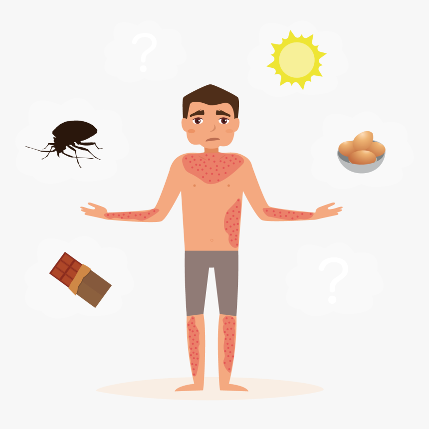 What Causes Hives, HD Png Download, Free Download