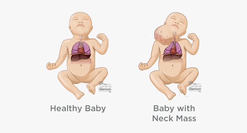 Fetal Bladder Outlet Obstruction, HD Png Download, Free Download