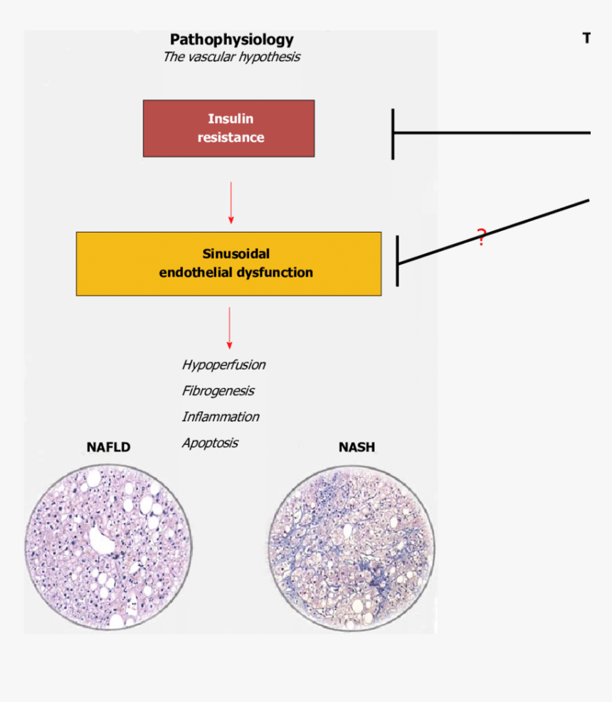 Fatty Liver In Sinusoid, HD Png Download, Free Download