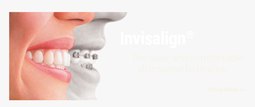 Barry Dentistry Invisalign Kirkland - Clear Aligners, HD Png Download, Free Download