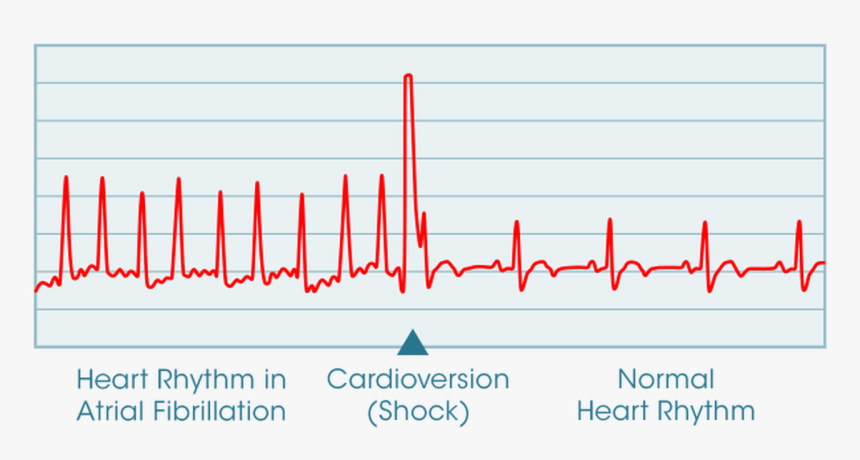 Cardioversion - Pre Cardioversion, HD Png Download, Free Download