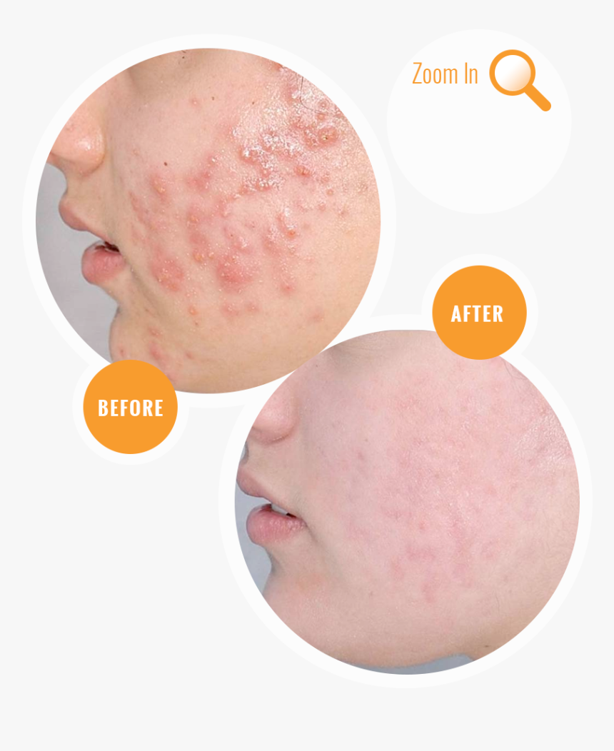 Acne Before And After Treatment, HD Png Download, Free Download