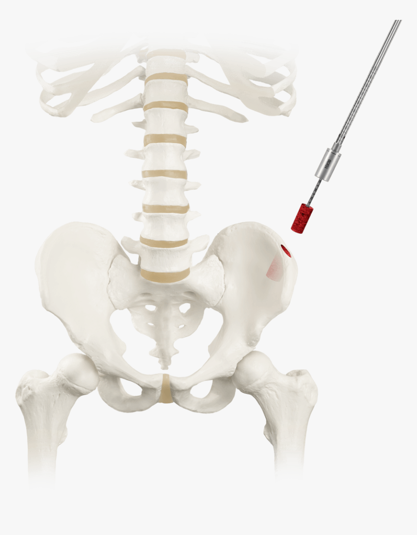 Retrieve® Bone Graft Harvest Removal - Skeleton, HD Png Download - kindpng