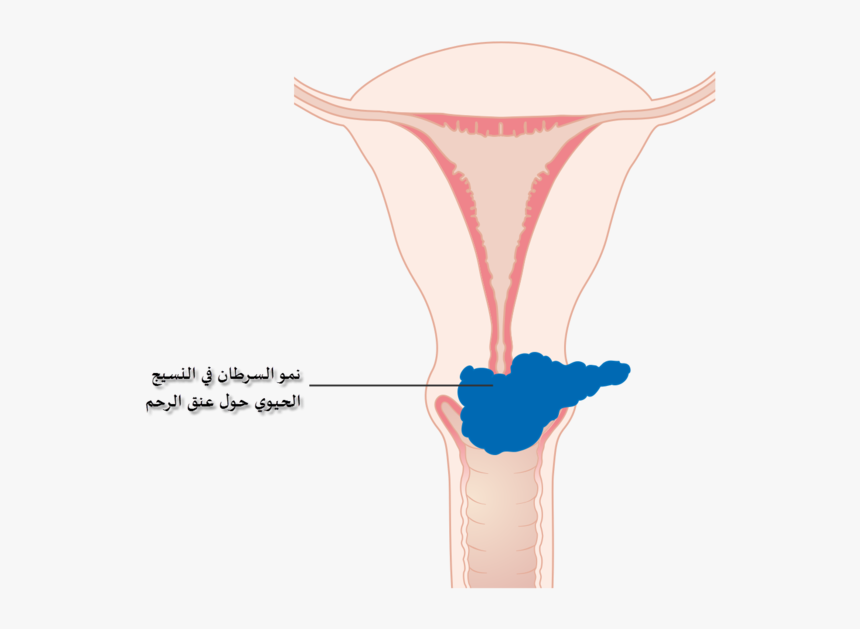 Diagram Showing Stage 2b Cervical Cancer Cruk 216-ar - Cervical Cancer Png, Transparent Png, Free Download