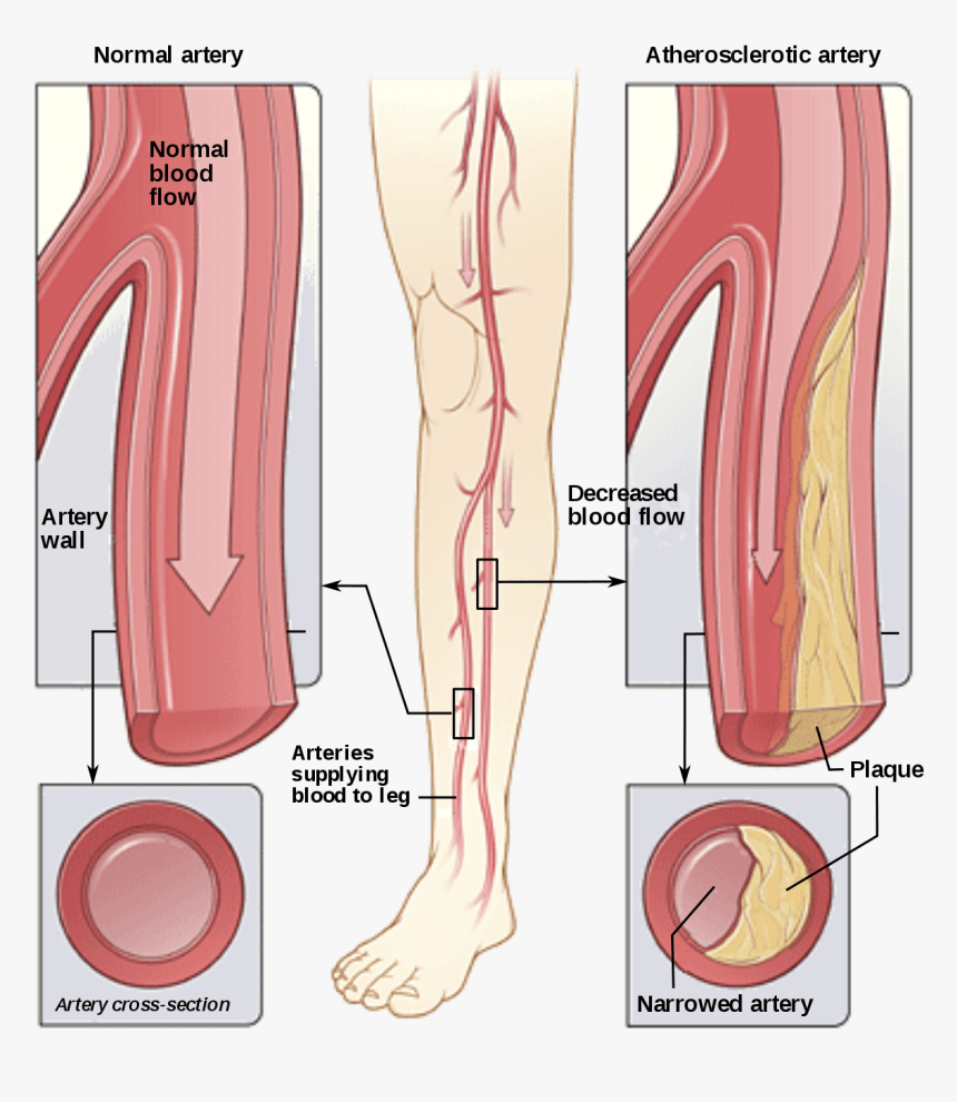 Peripheral Arterial Disease - Peripheral Artery Disease, HD Png Download, Free Download