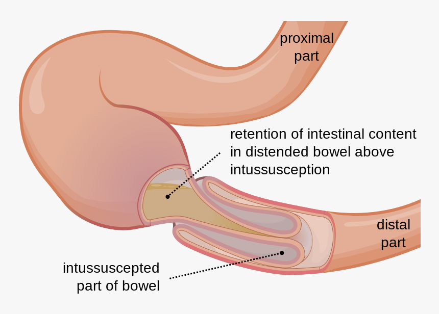 Bowel Intussusception, HD Png Download, Free Download