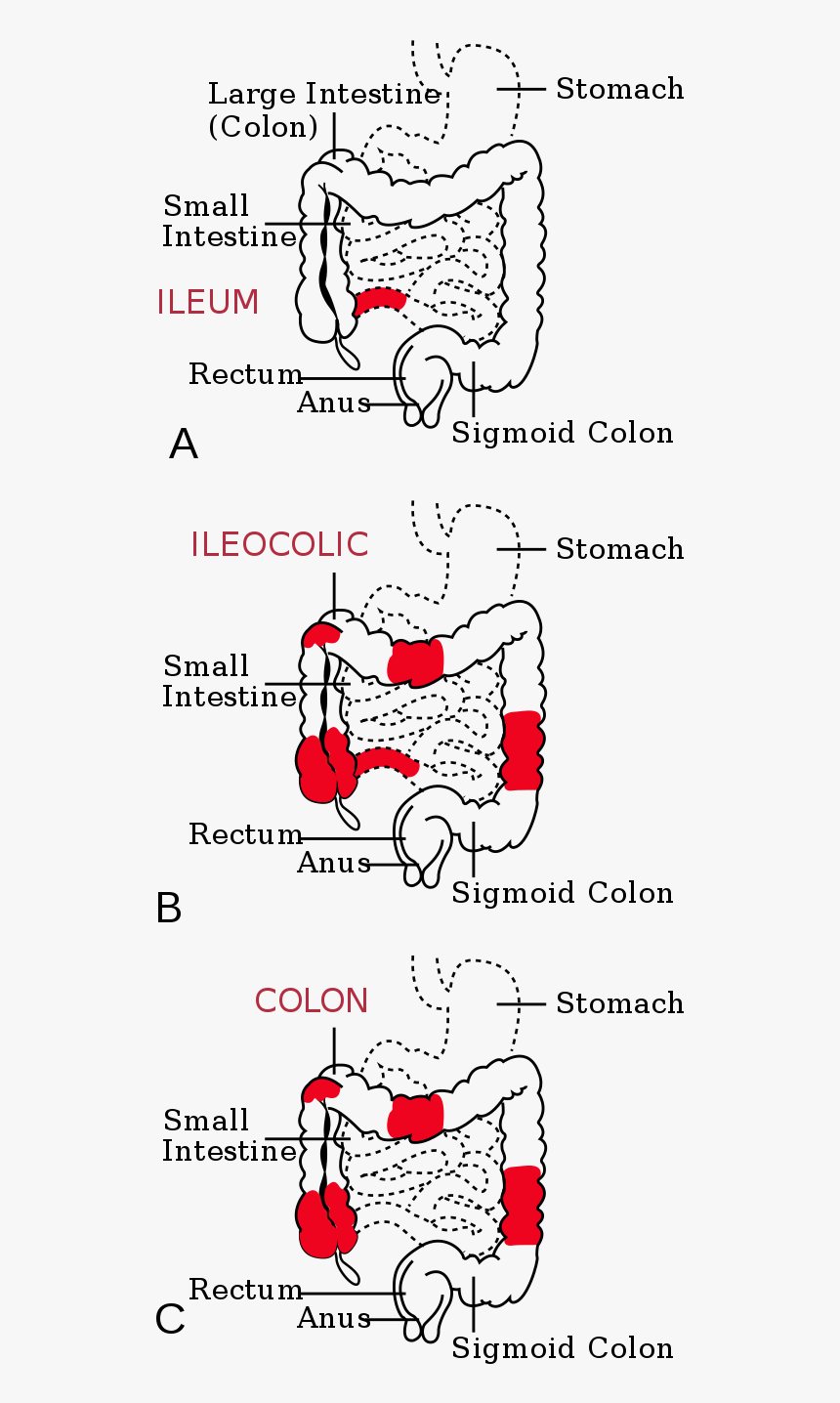 Crohn's Disease Site, HD Png Download, Free Download