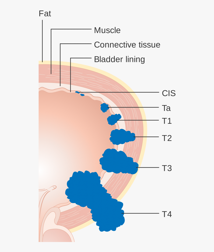 Bladder Reconstruction Surgery - Staging Of Bladder Cancer 8th Edition, HD Png Download, Free Download