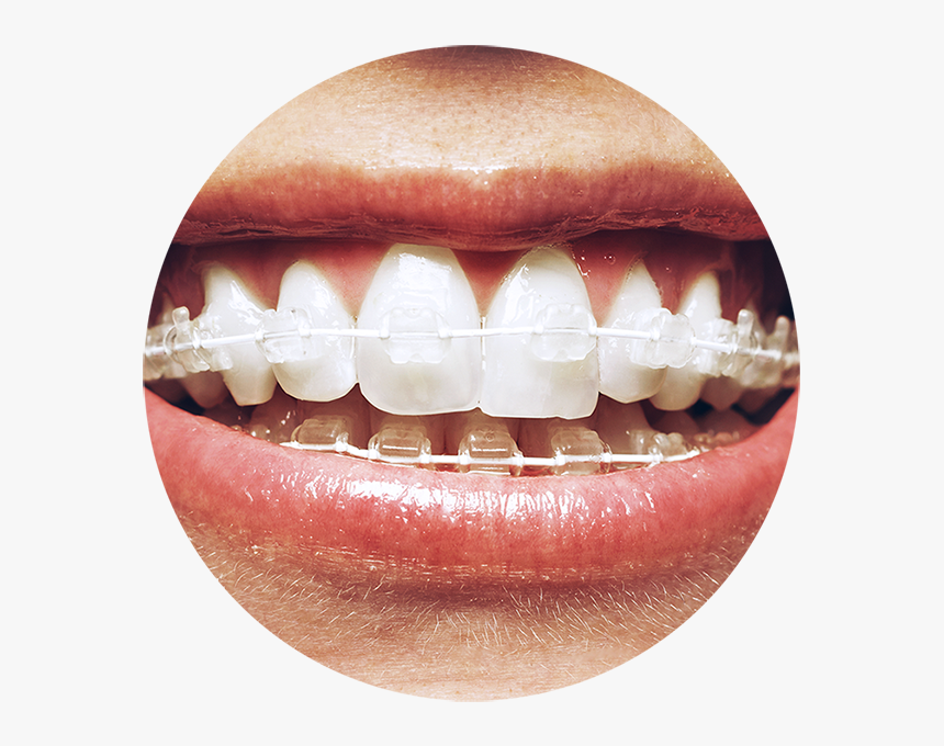 Transparent Smiling Mouth Png - 6 Month Smile Braces, Png Download, Free Download