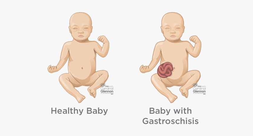 Gastroschisis - Blockage In Bladder, HD Png Download, Free Download