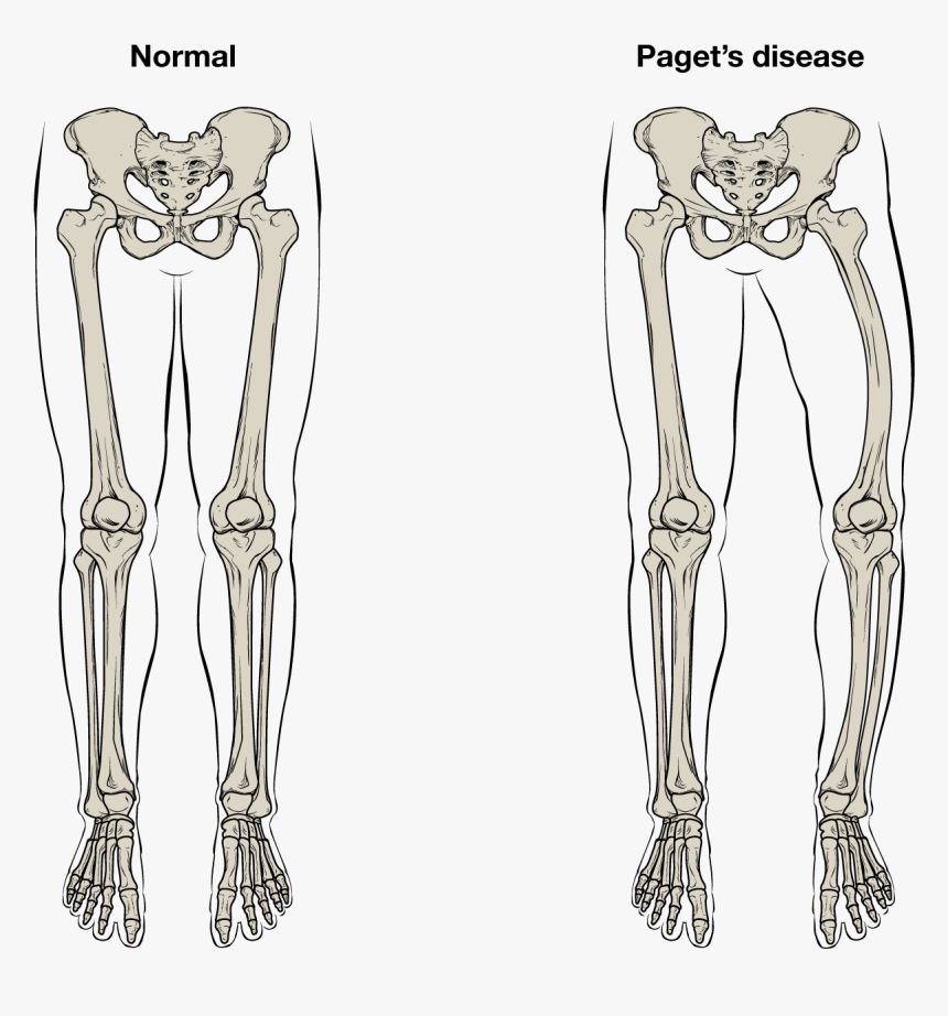 Clip Art Structure Anatomy And - Deformity Paget's Disease Bone, HD Png Download, Free Download