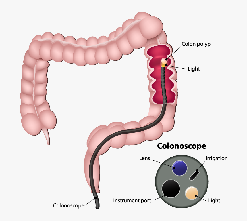 Colonoscopy, HD Png Download, Free Download