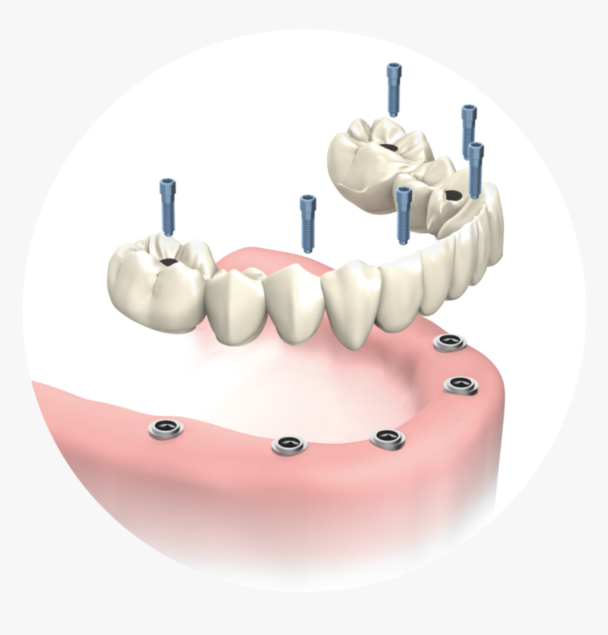 Implant Supported Dentures At Nyc Center For Dental - Cake Decorating, HD Png Download, Free Download