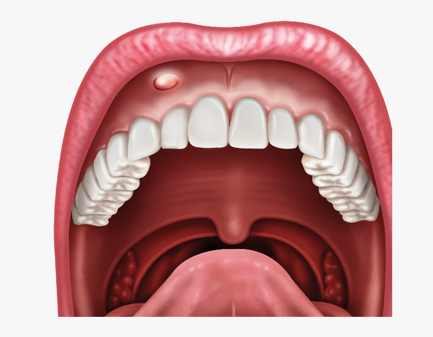 Illustration Of Open Mouth With Lesion, HD Png Download, Free Download