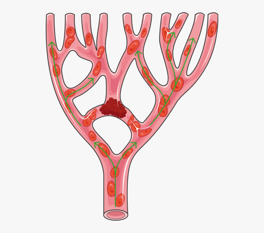 Thrombus Png, Transparent Png, Free Download