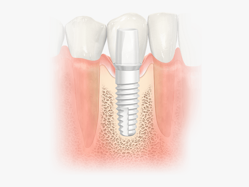 Dental Implant, HD Png Download, Free Download