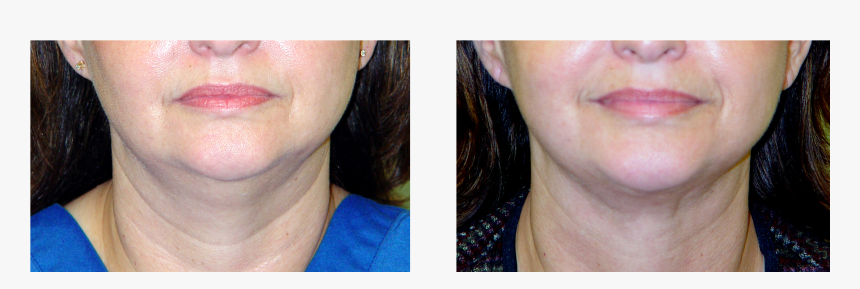 Chin Liposuction Before And After , Png Download - Close-up, Transparent Png, Free Download