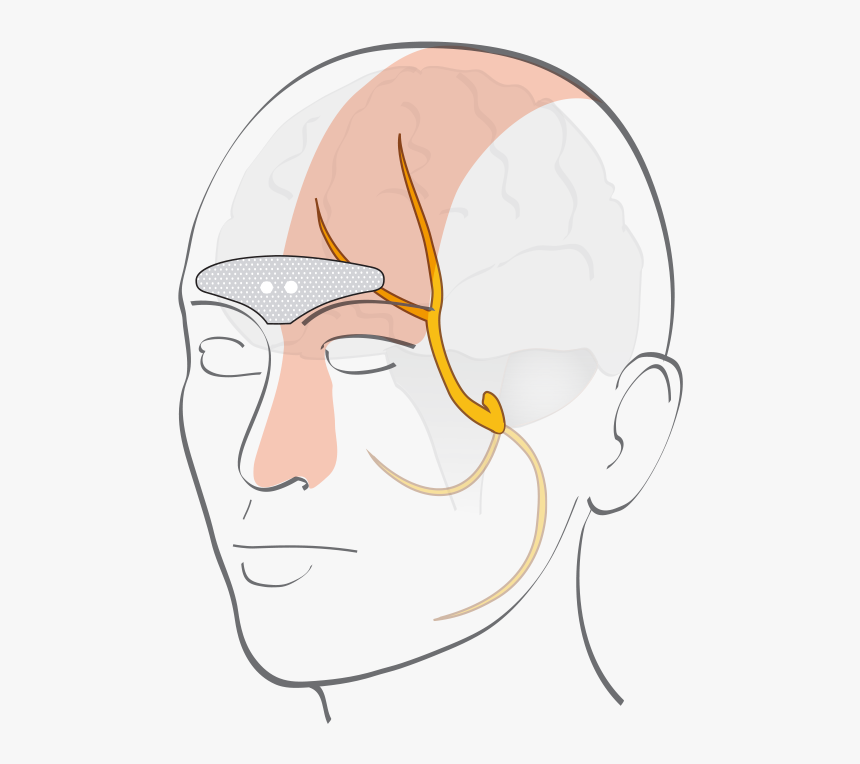 Cefaly - External Trigeminal Nerve Stimulation, HD Png Download, Free Download