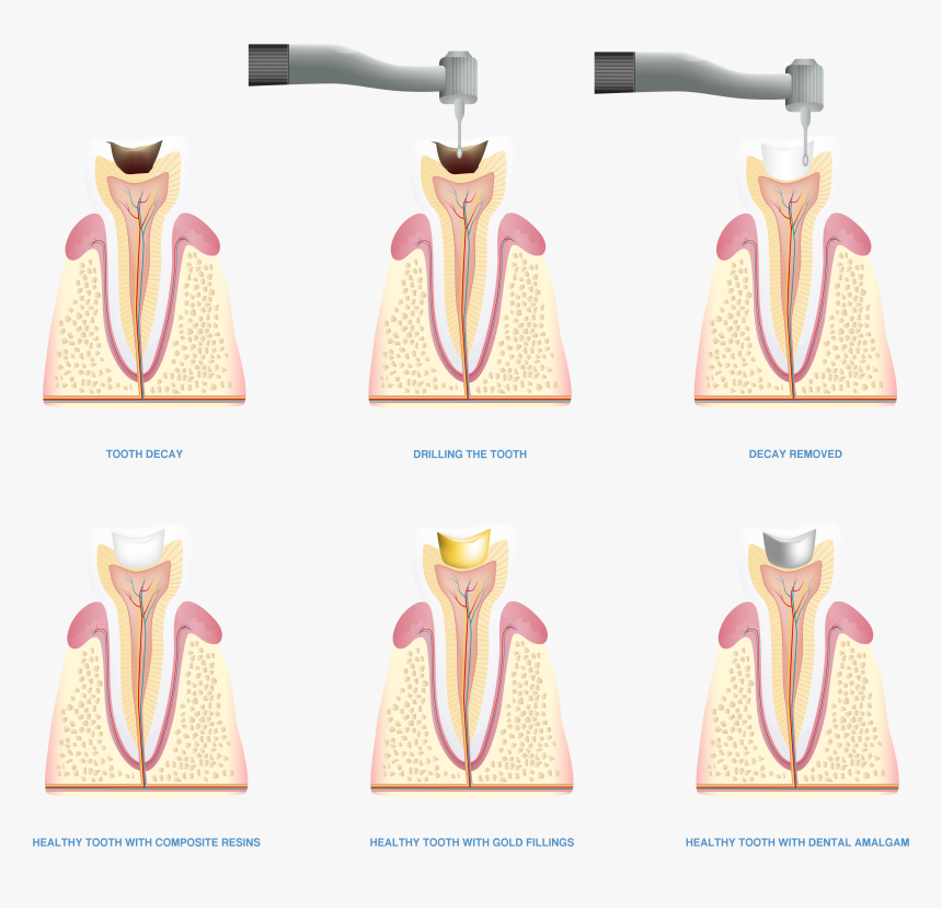 Tooth Filling Illustration - Small Appliance, HD Png Download, Free Download