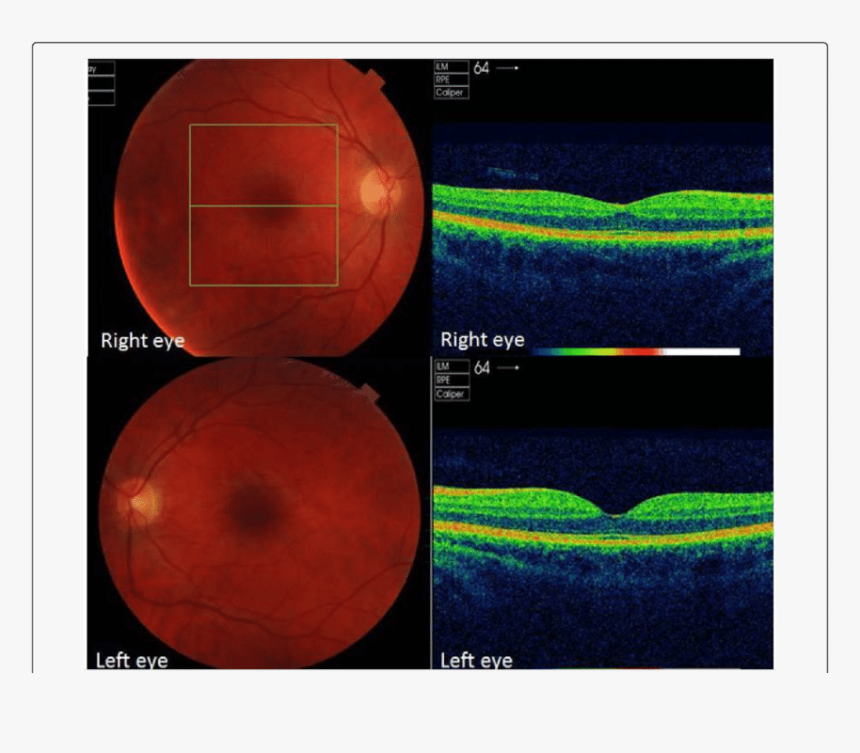 Posterior Segment Oct, HD Png Download, Free Download