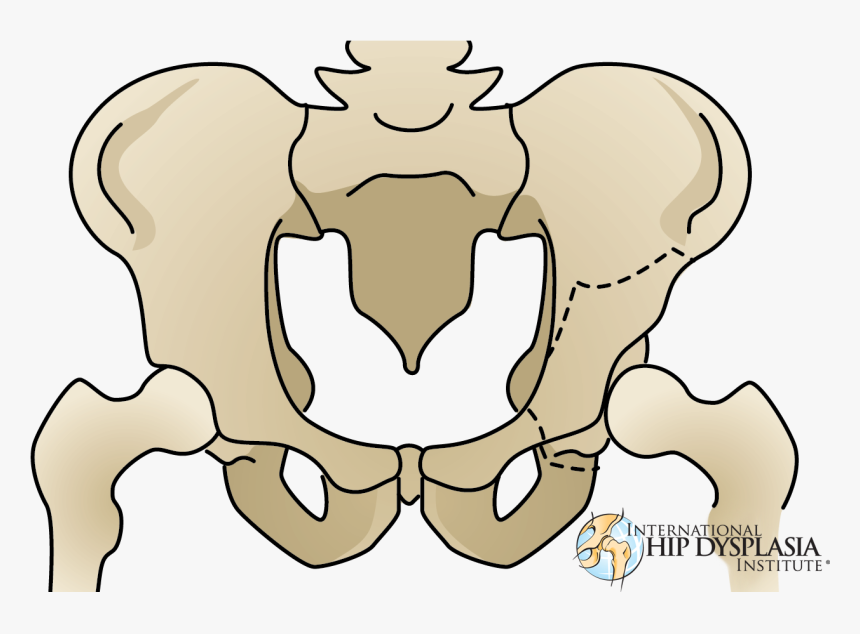 Ddh Osteotomy, HD Png Download, Free Download