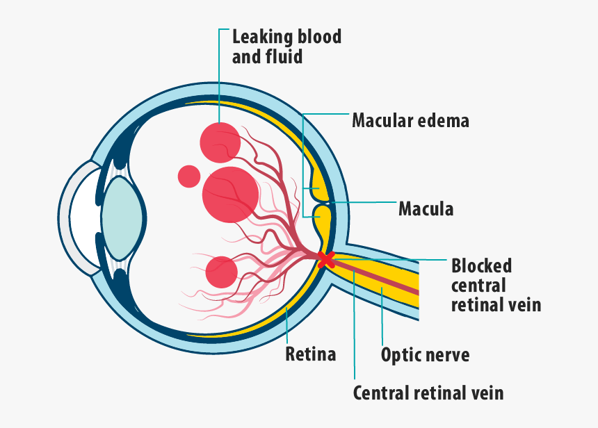 Picture Of Effects Of Mefcrvo On The Eye, Showing Leaking - Central Retinal Vein Occlusion Diagram, HD Png Download, Free Download