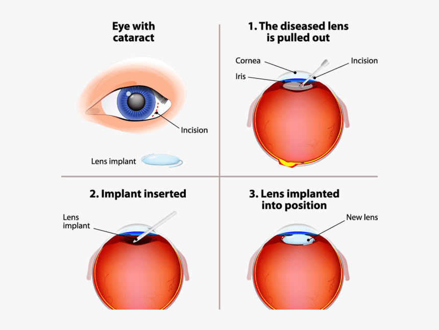 Cataract Surgery, HD Png Download, Free Download