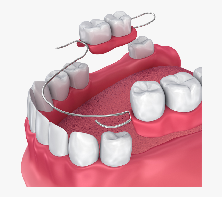 Partial Dentures, HD Png Download, Free Download