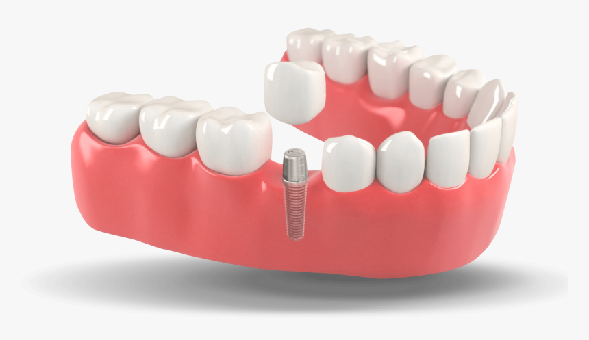 Menu-image - Dental Implants, HD Png Download, Free Download