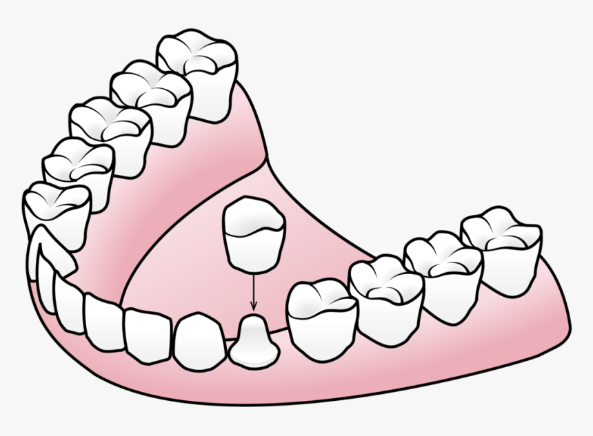 Porcelain Crowns Valley Dental And Orthodontics Clipart - Clip Back Of Teeth, HD Png Download, Free Download