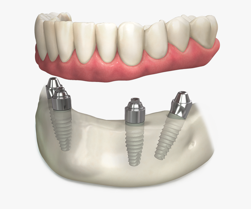 Абатмент Multi Unit. Multi Unit Abutment. Osstem Multi Unit. Имплант мультиюнит.