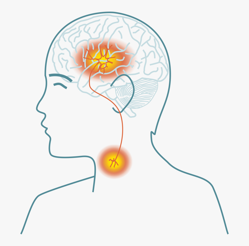 Stroke Disease Png, Transparent Png, Free Download