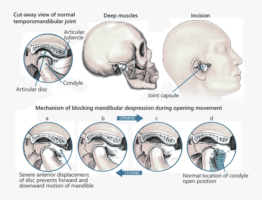 Tmj Specialist - Tmj Disorder, HD Png Download, Free Download