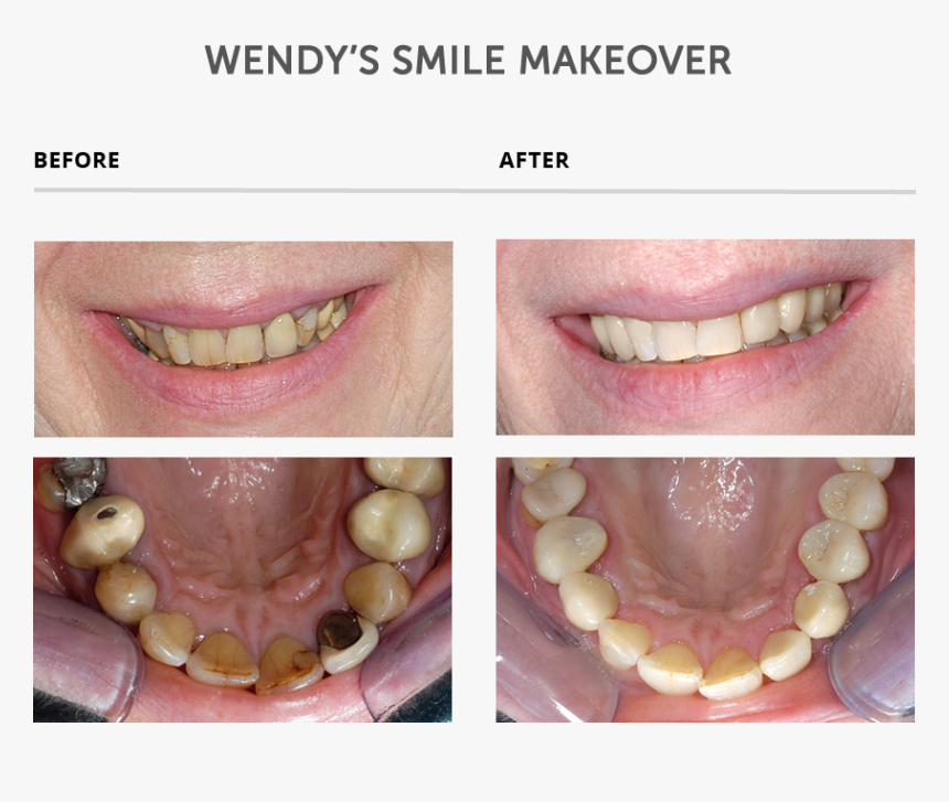 Weybridge Teeth Smile Makeover - Teeth Makeover, HD Png Download, Free Download