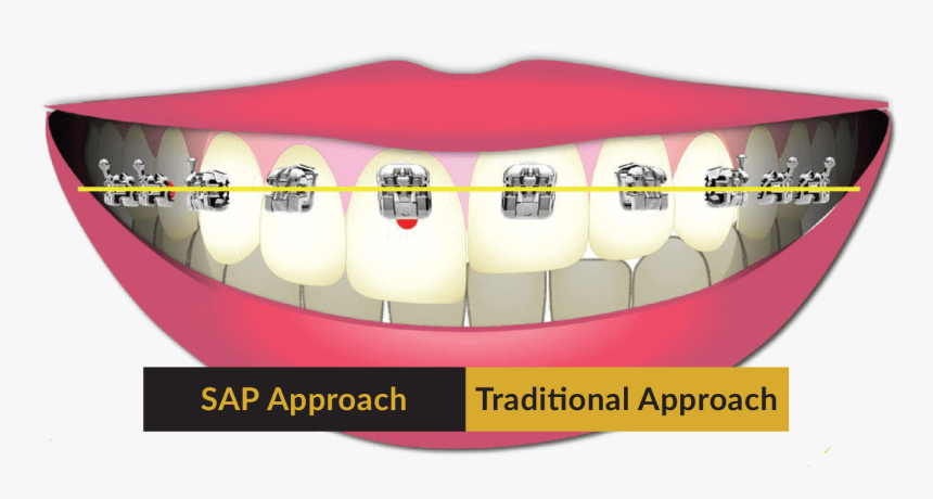 Sap Approach - Smile Arc Protection, HD Png Download, Free Download