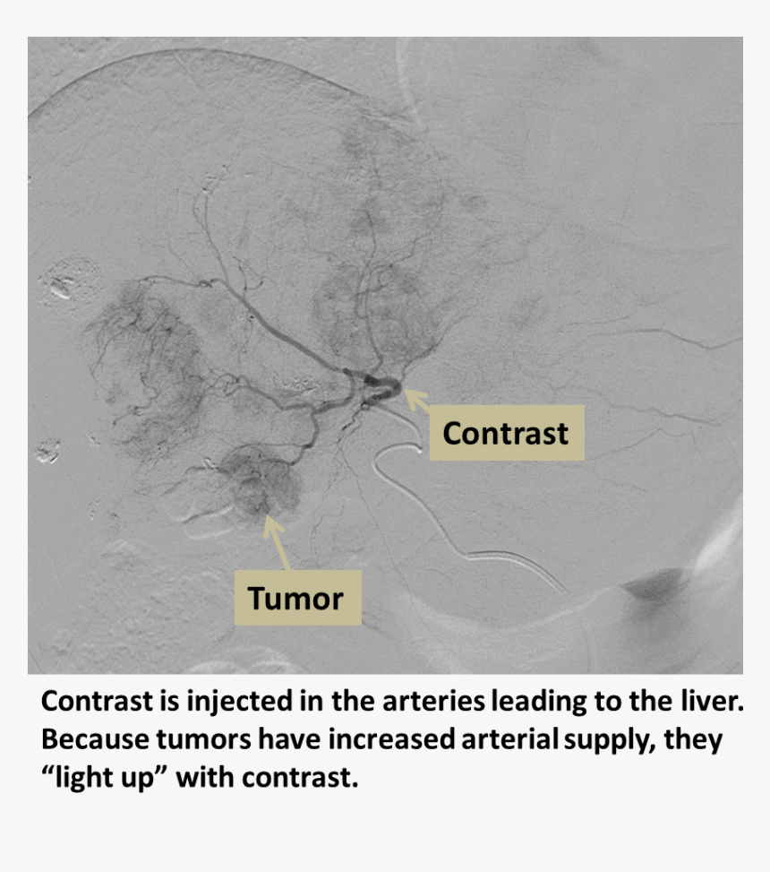 Chemoembolization Liver, HD Png Download, Free Download