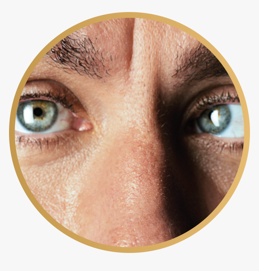 Crossed Eyes Strabismus, HD Png Download, Free Download