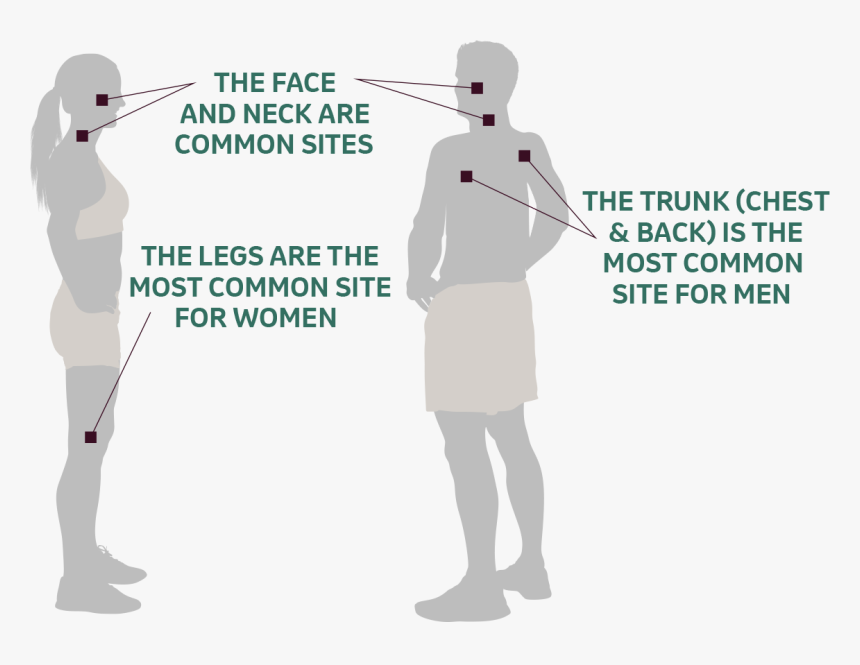 Melanoma In Men And Women, HD Png Download, Free Download