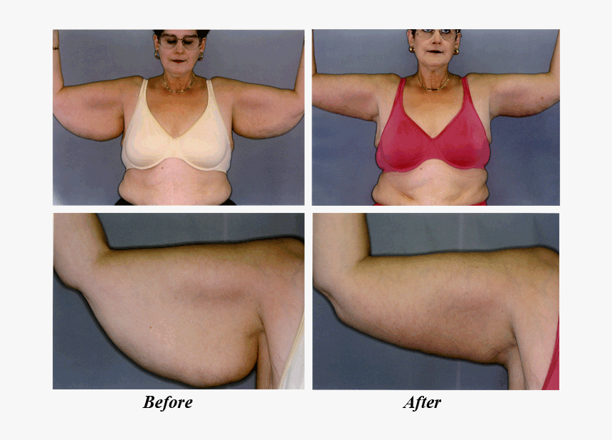 Before & After Arm Lift - Brassiere, HD Png Download, Free Download