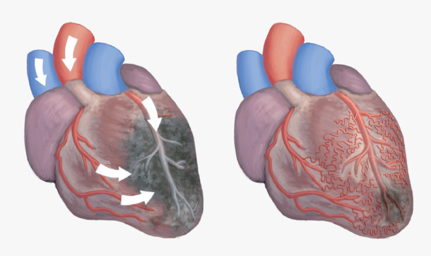 Alt="illustration Of Two Hearts, One Showing Ischemia - Eecp Effects On Heart, HD Png Download, Free Download