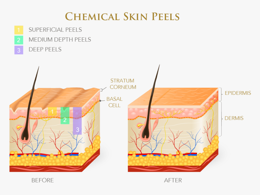 Infographic On Chemical Skin Peels - Layers Of Skin Chemical Peel, HD Png Download, Free Download