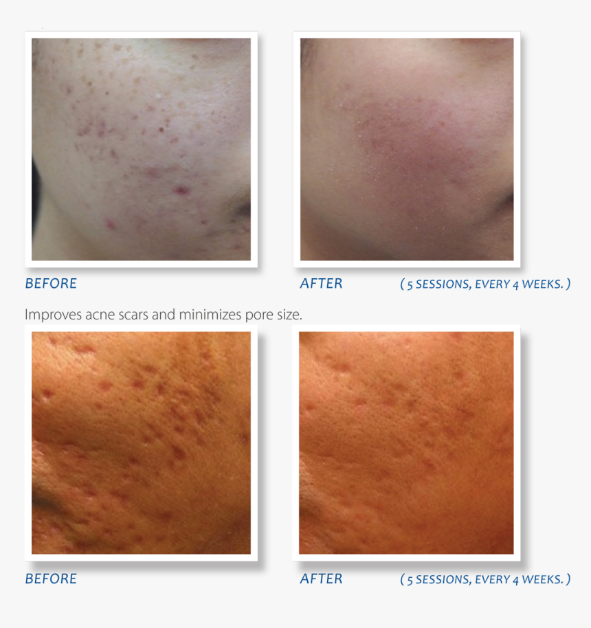 Microneedling Dermapen Before And After Milwaukee Evolvmd - Dermapen Inainte Si Dupa, HD Png Download, Free Download