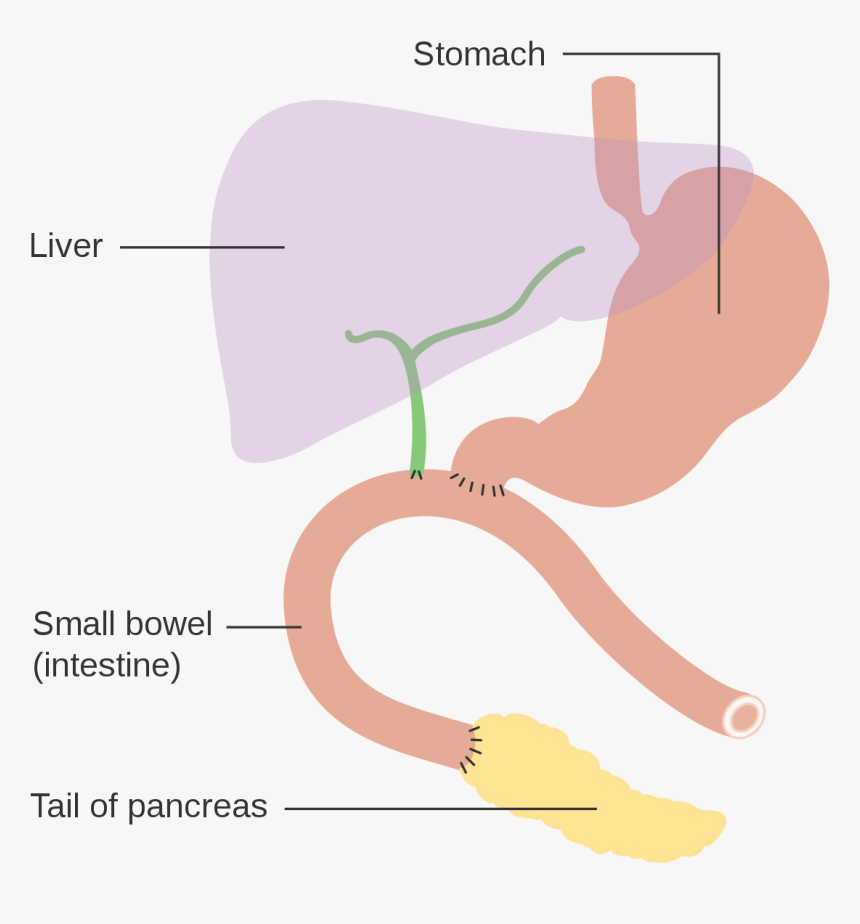 Pancreaticoduodenectomy, HD Png Download - kindpng